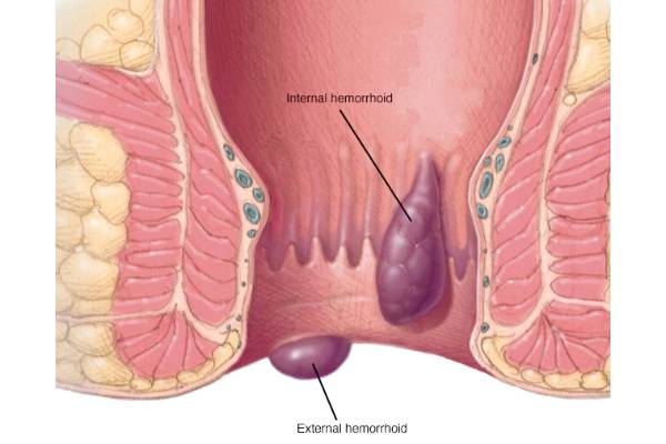 Laser Treatment for Piles in Pirangut - Mulshi Speciality Hospital